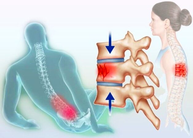 Anche un normale infortunio può innescare lo sviluppo dell'osteocondrosi