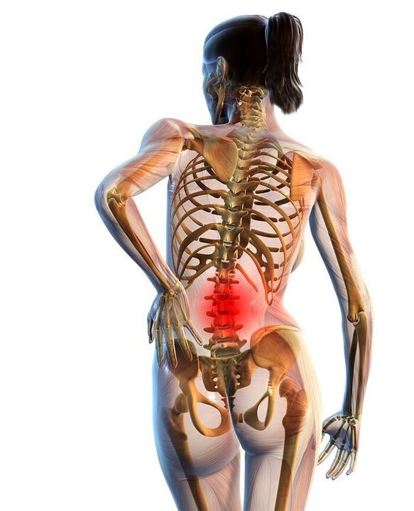 L'osteocondrosi della colonna lombare si verifica più spesso