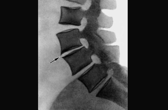 Manifestazioni di osteocondrosi della colonna vertebrale toracica su una radiografia